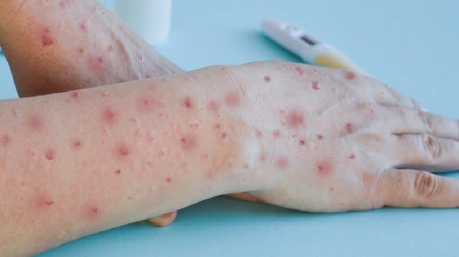 RN chega a 68 casos de varíola dos macacos e Saúde faz alerta